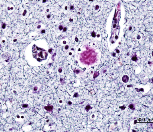 Une porte ouverte par les scientifiques japonais pour combattre Alzheimer